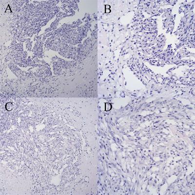 Renal pelvis metastasis following surgery for breast angiosarcoma: a case report and literature review